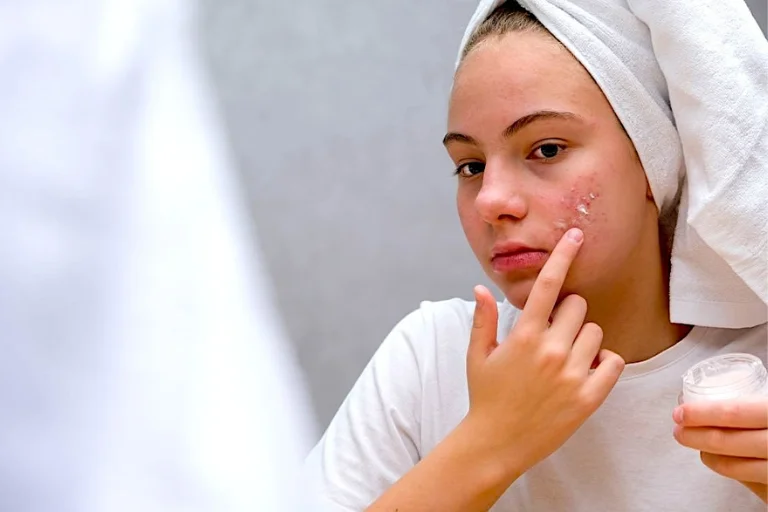 Cuidar de la piel por tener problemas de acné con la cosmética adecuada no es desaconsejable para las adolescentes.