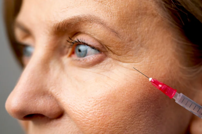 Ante el inevitable envejecimiento de la piel del rostro los rellenos dérmicos pueden mejorar y ayudar a atenuarlo.