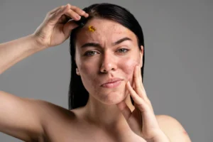 Acné efecto rebote Vibeofbeauty