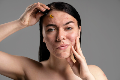 Acné efecto rebote Vibeofbeauty