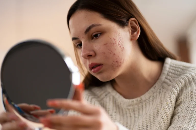 Bacteria acné Vibeofbeauty