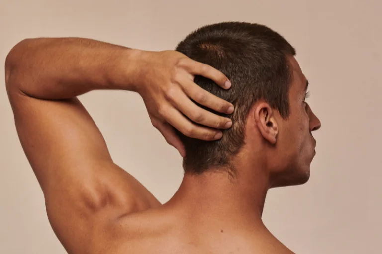 Transplante_capilar_sin_rapar_Vibeofbeauty