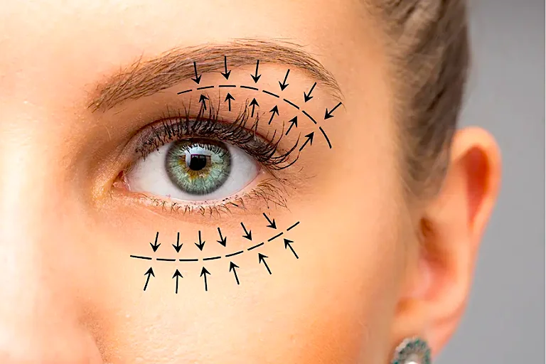 La blefaroplastia se centra en mejorar la mirada a través de una intervención quirúrgica en los párpados.
