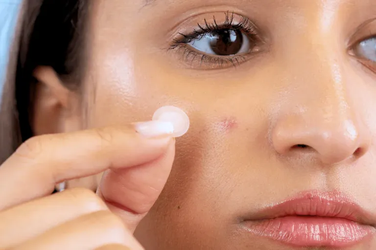 Los parches hidrocoloides forman parte de la línea oil-free de Mercadona y actúan sobre granitos de manera eficaz.