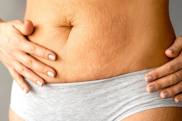 Los nuevos anticelulíticos como el que acaba de lanzar Mercadona se centrar en mejorar la piel de naranja.