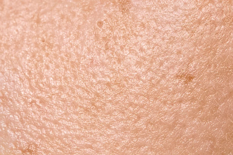 Una piel grasa con los poros muy dilatados necesita activos en la cosmética que no los obstruyan.