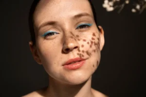 manchas-faciales-dermatologo-vibeofbeauty