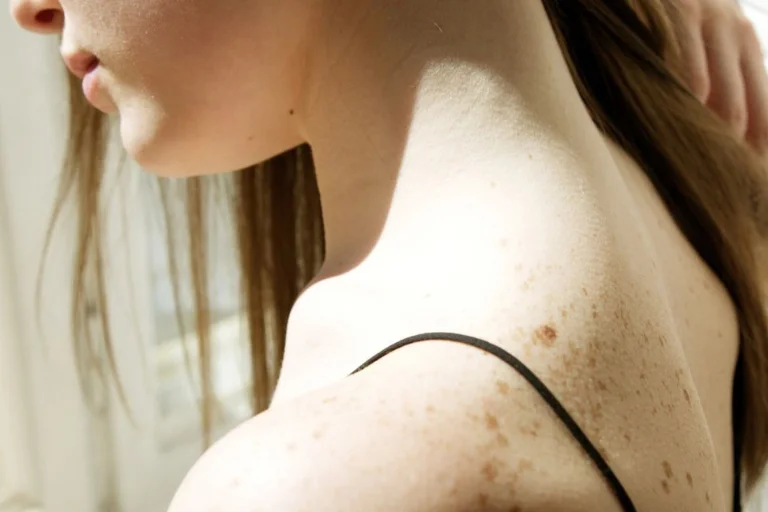 Manchas_blancas_piel_Vibeofbeauty